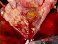 This shows that the tumor had encased all the organs in the abdomen, the gall bladder, the liver, and the intestinal track