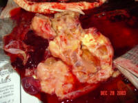 This shows that the tumor had encased all the organs in the abdomen, the gall bladder, the liver, and the intestinal track